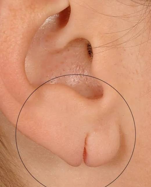 Expert earlobe repair services in Hyderabad to restore the natural shape of damaged earlobes