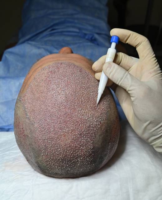 Hair Transplantation in Hyderabad