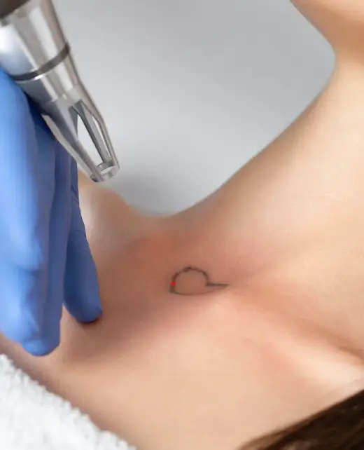 laser-tattoo-removal-banner